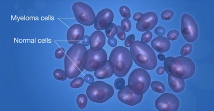 Multiple Myeloma Overview